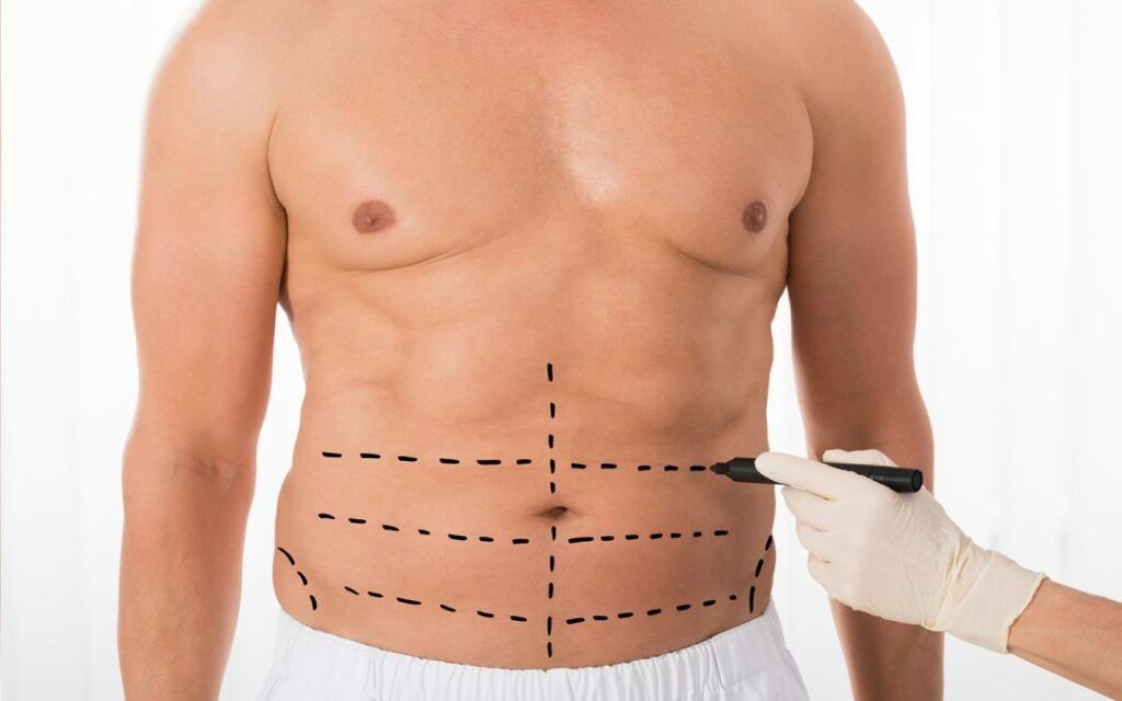 Abdominoplastia